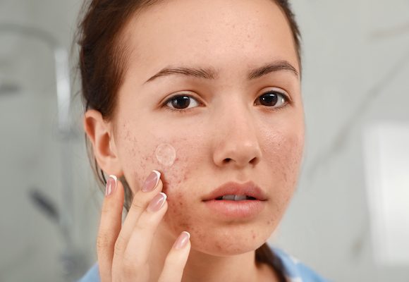 El acné es una enfermedad de la piel que se caracteriza por la inflamación de las glándulas sebáceas y la aparición de espinillas y granos. Aunque aparece, principalmente, durante la etapa de pubertad, existen casos en los que se presenta a partir de los 18 años, cuando ya se denomina acné adulto.
