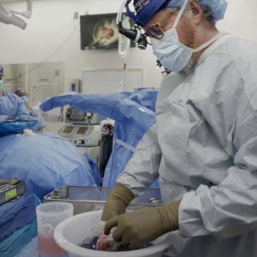 El avance médico marca el riñón de cerdo más largo que ha funcionado en un ser humano, preparando el escenario para operaciones en pacientes vivos